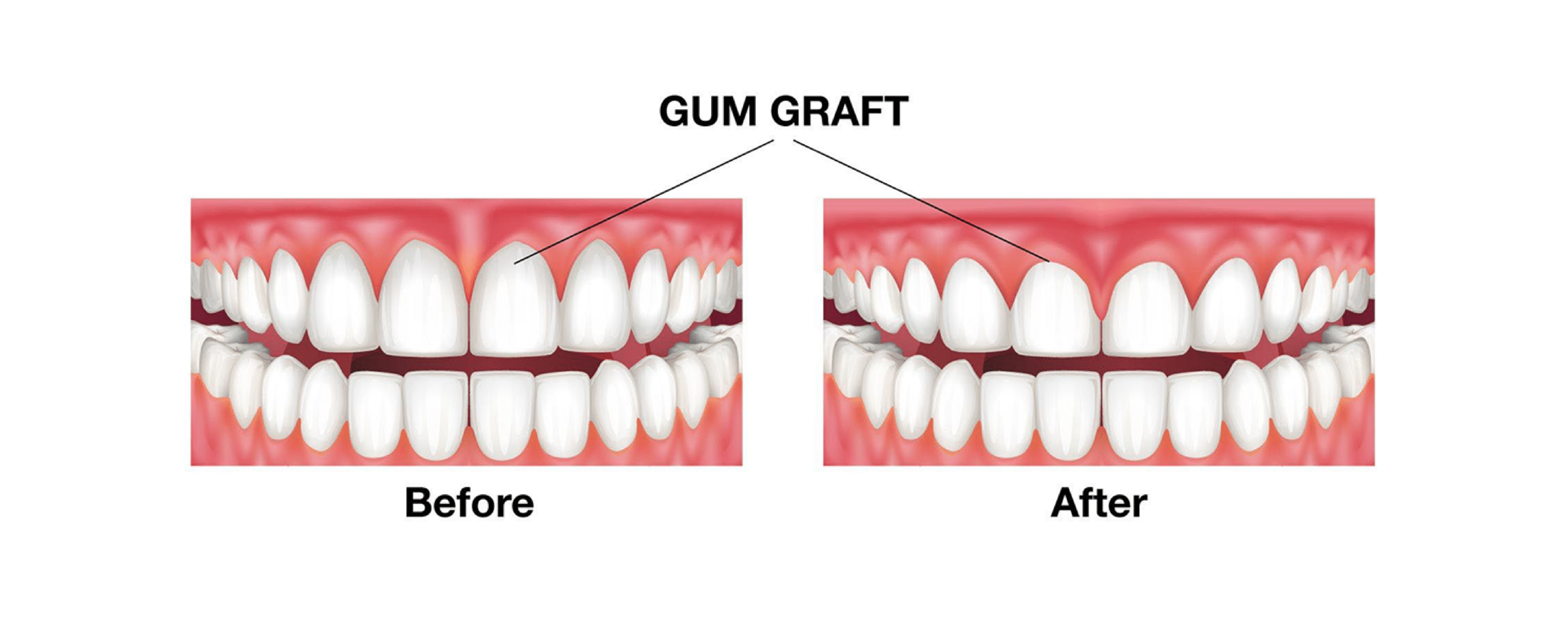 Gum Grafting 01